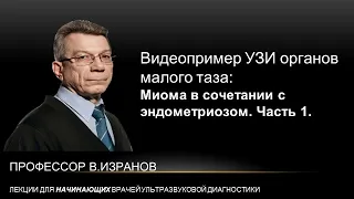 Видео пример: УЗИ малого таза. Миома в сочетании с аденомиозом. Часть 1.