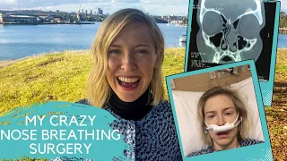 My Nasal Airway Surgery (Deviated Septum) & How It STOPPED My Mouth Breathing For Good.