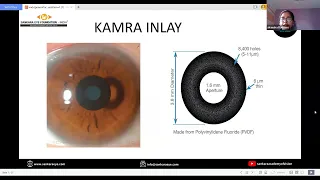 Surgical options for presbyopia - Cornea, Lens and Sclera