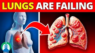 Top 10 Early Warning Signs of Pneumonia | DON'T IGNORE! ⚠️