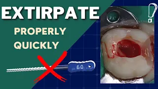 How To PROPERLY and QUICKLY Extirpate (Acute Pain) - GF016