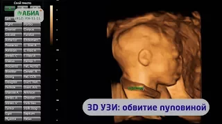 3D УЗИ: обвитие пуповиной