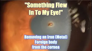 How to remove a metal fragment from the eye.  Corneal foreign-body removal.