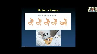 Strategies for Management of Atrial Fibrillation: State of the Art in 2023