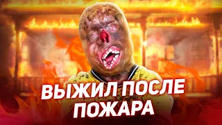 🔥 ВЫЖИЛ ПОСЛЕ ПОЖАРА / 95% ОЖОГОВ [Добрый Волшебник]