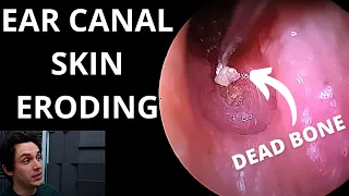 Ear Canal Skin Erosion Caused By Canal Cholesteatoma (Dead Bone Tested Under Microscope)