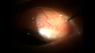 Bleb needling on slit-lamp