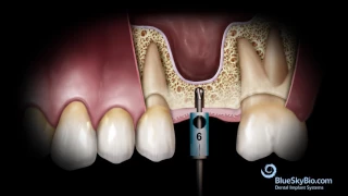 Advanced Simplified Sinus Lift Technique (No Probe)