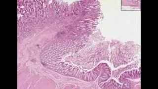 Histopathology Colon--Adenocarcinoma