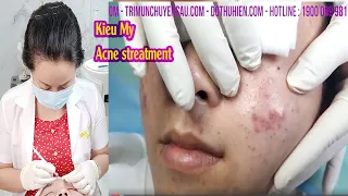 Hidden acne treatment I Điều trị mụn hiệu quả số 1 Hiền Vân Spa I Nguyễn Phạm Kiều My I 500