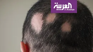 صباح العربية | الثعلبة وعلاجاتها