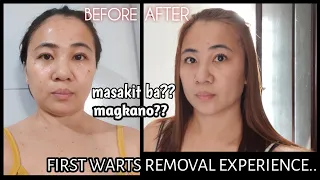 My first warts removal experience (face and neck) | Electrocautery warts removal