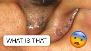 UNBELIEVABLE !!! AN EAR FULL OF BLACKHEADS😨... SATISFYING VIDEO #2 #relaxing #blackheads