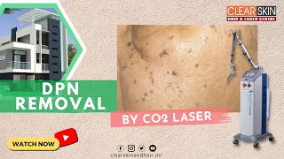 DPN removal Treatment by Co2 laser || Best Laser Removal for Dermatosis Papulosa Nigra | Dr.Kailash