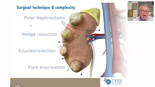 Urowebinar: Update on robot assisted partial nephrectomy