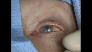 Severing of a lateral tarsorrhaphy