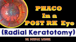 Phacoemulsification in a Post RK eye ( Radial Keratotomy) : Understanding the Strategies.