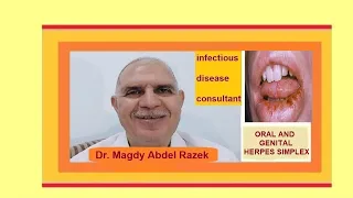 TREATMENT OF ORAL AND GENITAL HERPES SIMPLEX