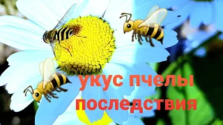 ужалила пчела. ужасная аллергия.