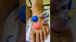 Dry Cupping/Wet Cupping For Foot Early Stage Neuropathy | #cupping #shorts |