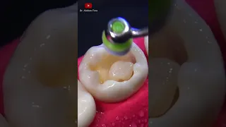 Dental filling procedure #satisfying