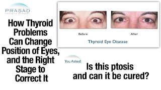 How Thyroid Eye Disease/Graves' Disease Affects Eye and Eyelid Position