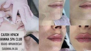 Збільшення губ в Івано-Франківську .❤Контурна пластика губ в салоні краси SAVANNA - лікар косметолог