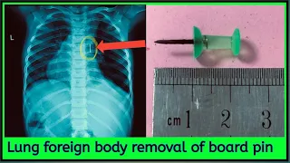 Removal of Inhaled Foreign Body From The Lung With Bronchoscopy #BD_ENDOSCOPY
