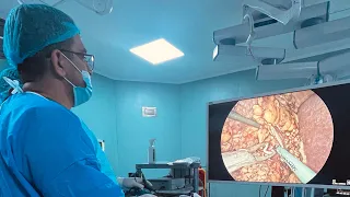 Laparoscopic partial Nephrectomy posterior tumor استئصال ورم الكلية الجزئي بمنظار البطن لابروسكوبي