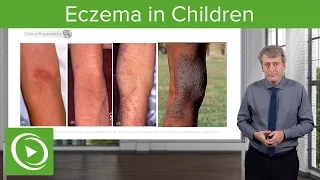 Eczema in Children – Pediatrics | Lecturio