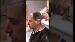 Пересадка волос в Турции | 5000 графтов техникой FUE Sapphire