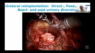 UROWebinar:  Advanced robotic ureteral reconstruction