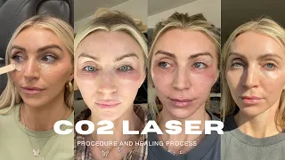 I GOT A CO2 LASER FOR MY UNDER EYE WRINKLES + LOOSE SKIN | is it worth it? daily check ins