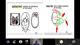 Lecture 9  ExtraOcular Muscles disorders