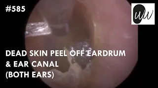 585 - Dead Skin Peel off Eardrum & Ear Canal Both Ears