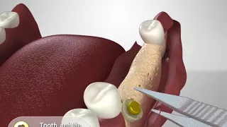 Bone augmentation