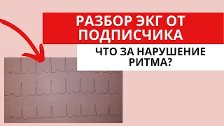 Наджелудочковая тахикардия? Разбор ЭКГ от подписчика.