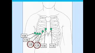 Inferior STEMI right ventricular involvement