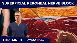 Superficial Peroneal Nerve Block - Crash course with Dr. Hadzic
