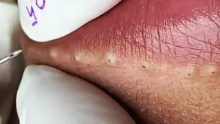 BEAUTY OF SQUEEZE😨 BLACKHEADS REMOVAL FROM THE LIPS #2  #relaxing  #blackheads