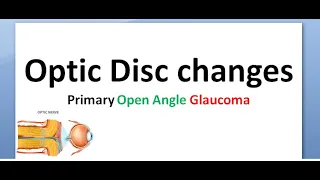 Ophthalmology 236 b Optic Disc Changes Early Advanced Atrophy signs Primary Open Angle Glaucoma POAG