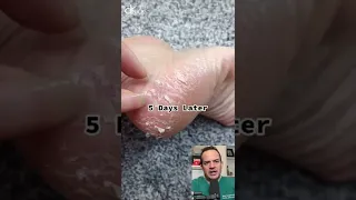DOCTOR REACTS TO CHEMICAL FOOT PEEL!😱😫 #shorts #reaction