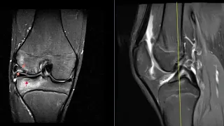 17 year old with OCD and stress fracture of knee