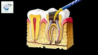 Root Canal Treatment Animation 3D Molar