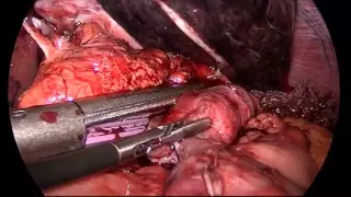 Step-by-Step Laparoscopic Revision of Roux-en-Y Gastric Bypass