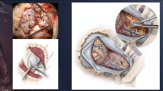 Far Lateral Approach - Aaron Cohen-Gadol, M.D. - Clinical Use - Part 1