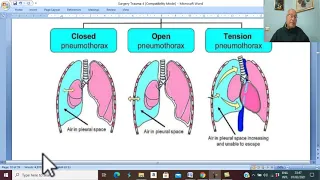 Trauma in Arabic 23 ( Pneumothorax , part 1 ) , by Dr. Wahdan .