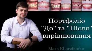 Портфоліо «До» та «Після» вирівнювання зубів | Брекети | Марк Харченко | стоматолог