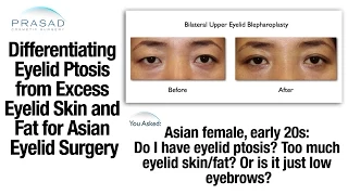 The Difference Between Eyelid Ptosis and Raising an Asian Eyelid Crease