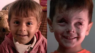 空爆で視力を失った3歳児、1年たって…　シリア